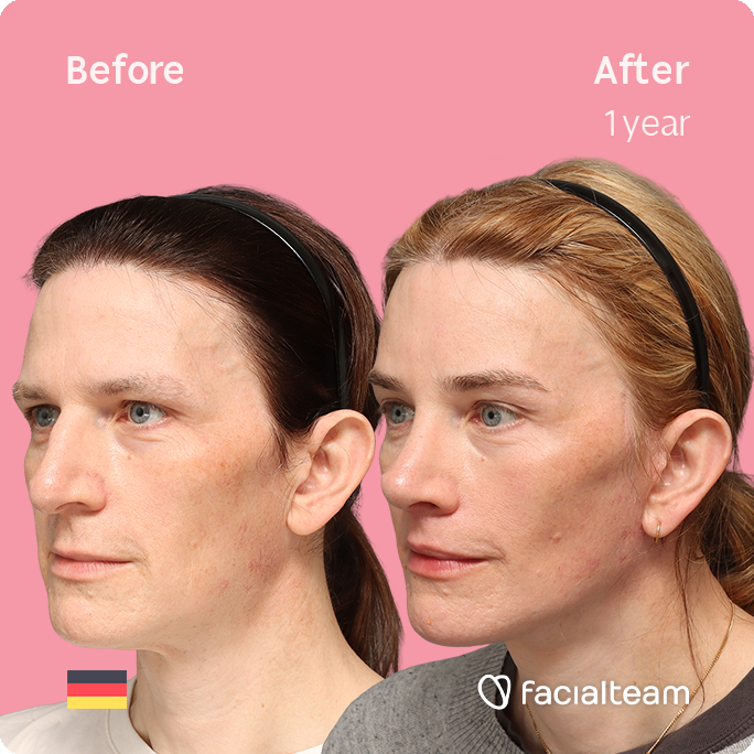 Fotografía cuadrada en ángulo del perfil izquierdo de Nina S, mostrando su transformación antes y después de la FFS con Facialteam: frente, rinoplastia y reducción de la nuez, con lifting cervicofacial y feminización de labios como tratamientos complementarios.