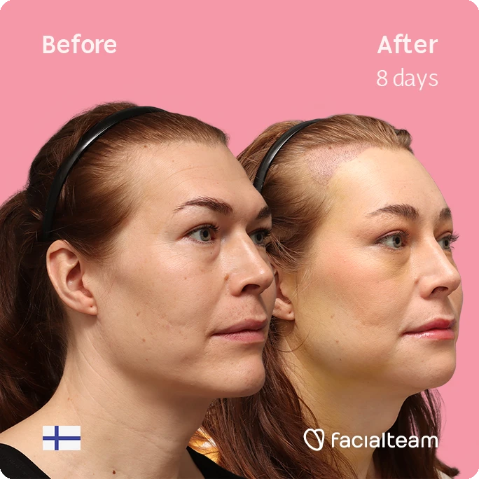 Fotografía cuadrada en ángulo del perfil derecho de Juuli, mostrando su transformación antes y después de la FFS con Facialteam.