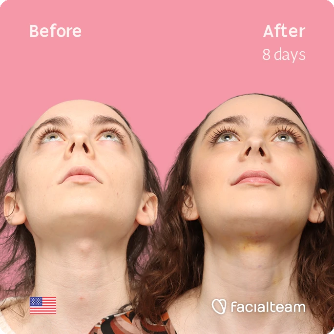 Fotografía frontal cuadrada en ángulo superior de Alex M, mostrando su transformación antes y después de la FFS con Facialteam: frente, mentón y reducción de la nuez.