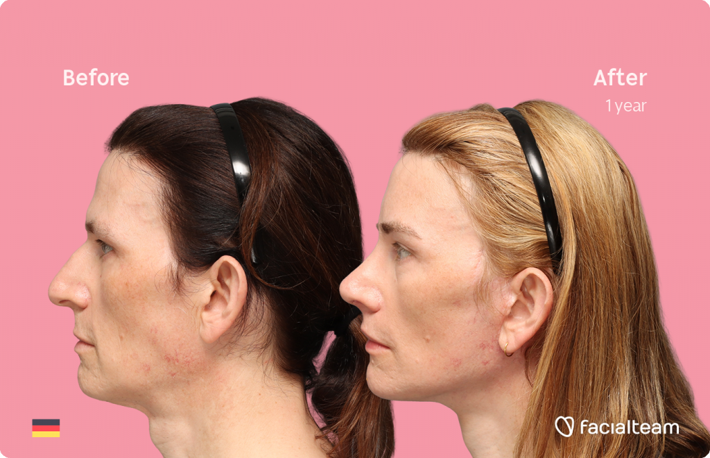 Fotografía del perfil izquierdo de Nina S, mostrando su transformación antes y después de la FFS con Facialteam: frente, rinoplastia y reducción de la nuez, con lifting cervicofacial y feminización de labios como tratamientos complementarios.