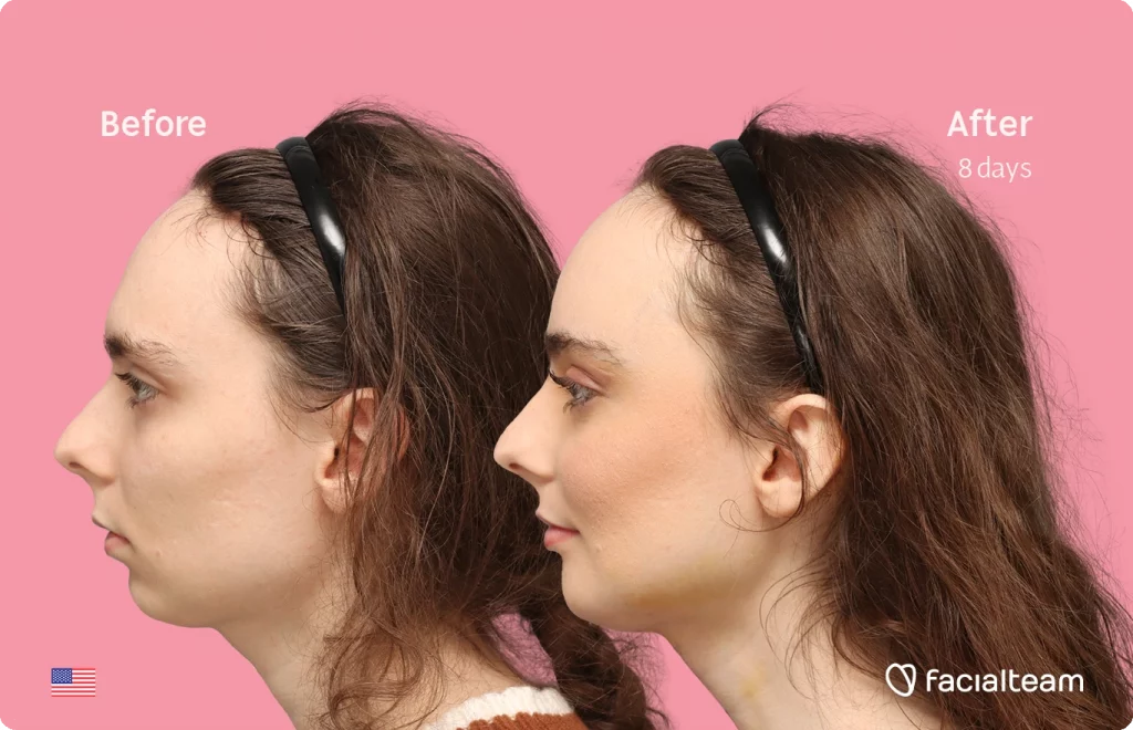 Fotografía del perfil izquierdo de Alex M, mostrando su transformación antes y después de la FFS con Facialteam: frente, mentón y reducción de la nuez.