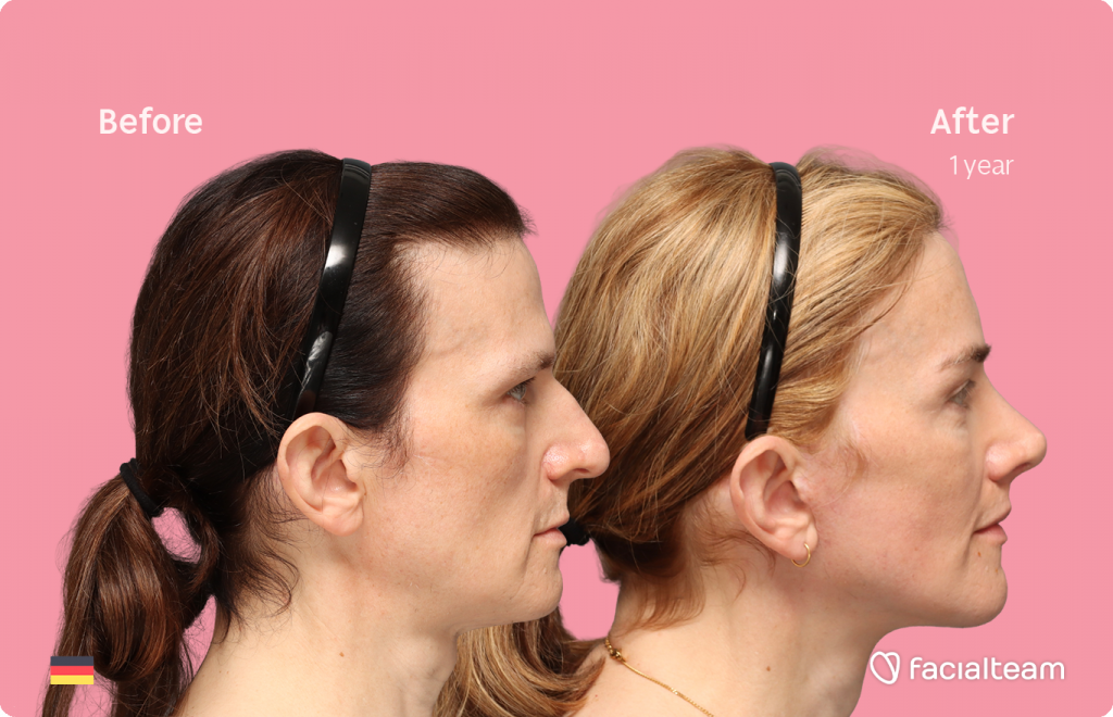 Fotografía del perfil derecho de Nina S, mostrando su transformación antes y después de la FFS con Facialteam: frente, rinoplastia y reducción de la nuez, con lifting cervicofacial y feminización de labios como tratamientos complementarios.