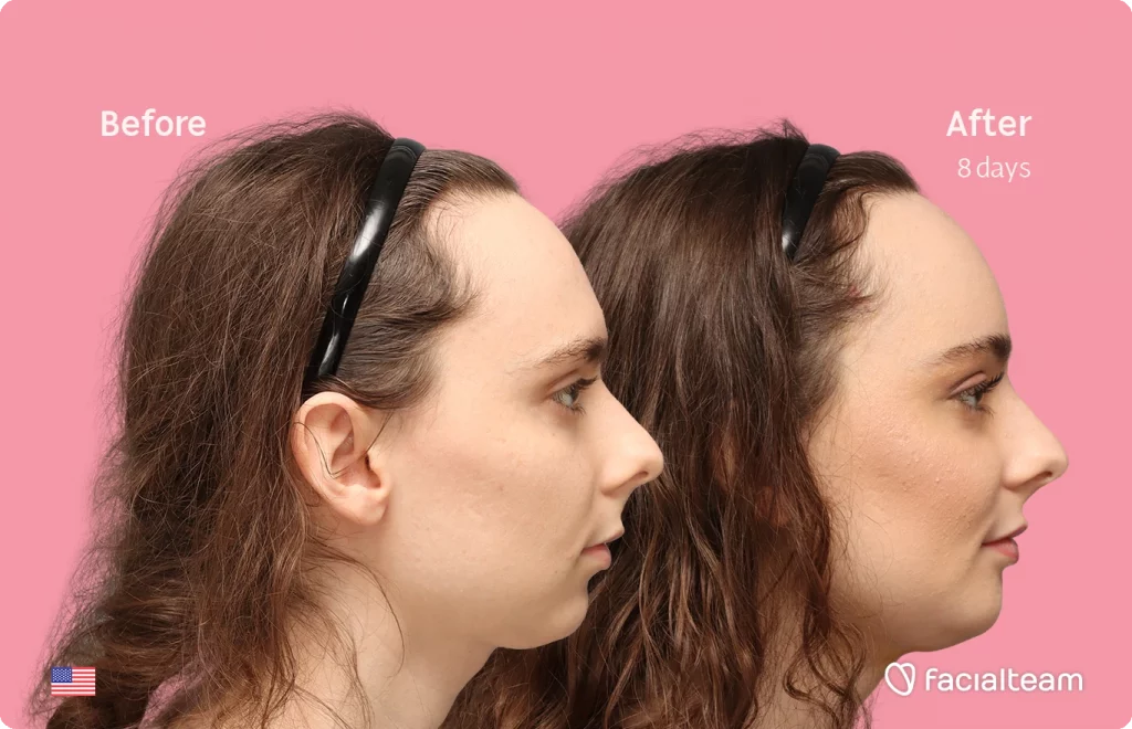 Fotografía del perfil derecho de Alex M, mostrando su transformación antes y después de la FFS con Facialteam: frente, mentón y reducción de la nuez.