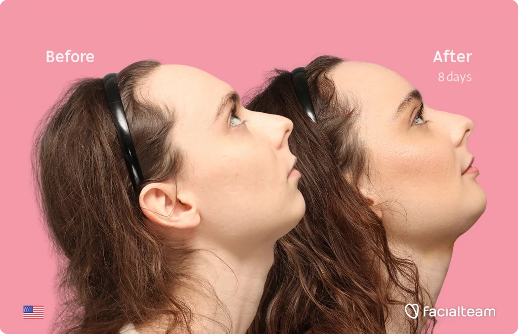 Fotografía del perfil derecho en ángulo superior de Alex M, mostrando su transformación antes y después de la FFS con Facialteam: frente, mentón y reducción de la nuez.