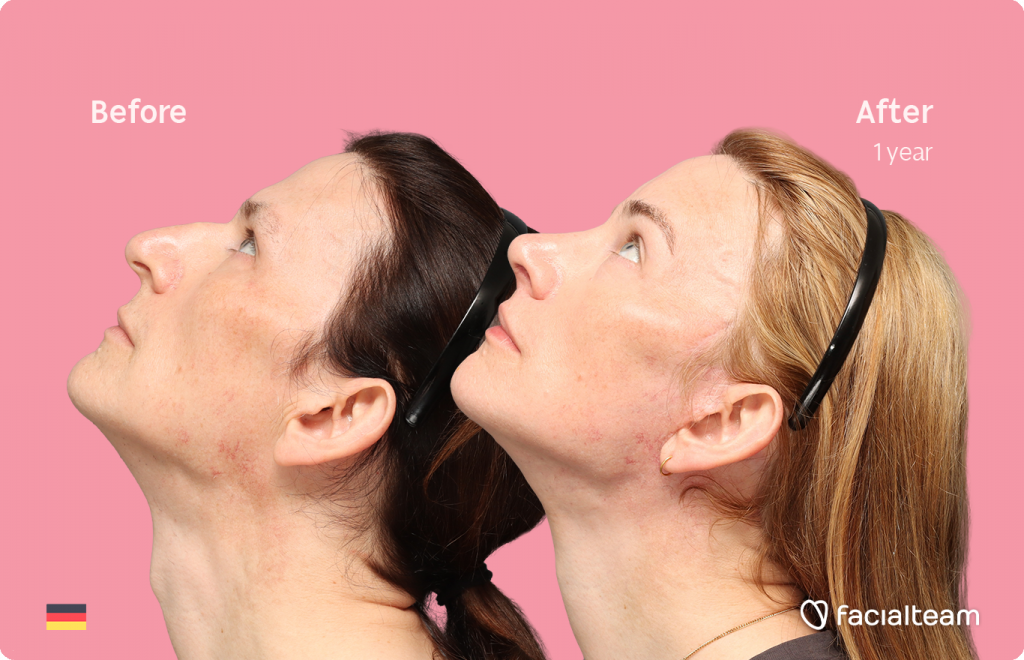 Fotografía del perfil derecho en ángulo superior de Nina S, mostrando su transformación antes y después de la FFS con Facialteam: frente, rinoplastia y reducción de la nuez, con lifting cervicofacial y feminización de labios como tratamientos complementarios.