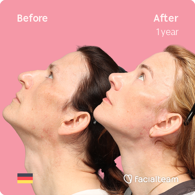 Fotografía cuadrada del perfil derecho en ángulo superior de Nina S, mostrando su transformación antes y después de la FFS con Facialteam: frente, rinoplastia y reducción de la nuez, con lifting cervicofacial y feminización de labios como tratamientos complementarios.