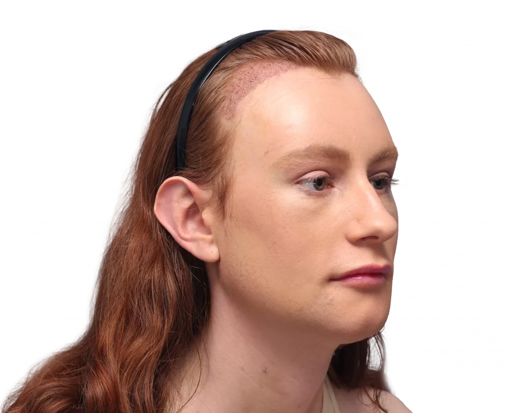 Foto en ángulo del perfil derecho de Annah después de la cirugía.