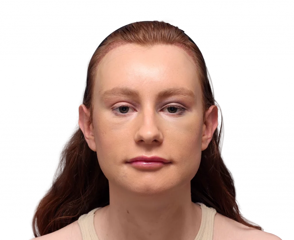 Foto de perfil frontal de Annah después de la cirugía.