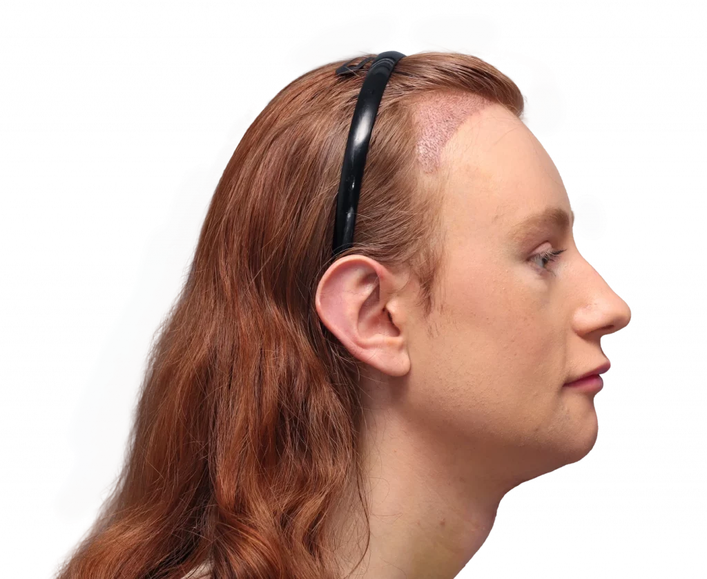 Foto del perfil derecho de Annah después de la cirugía.