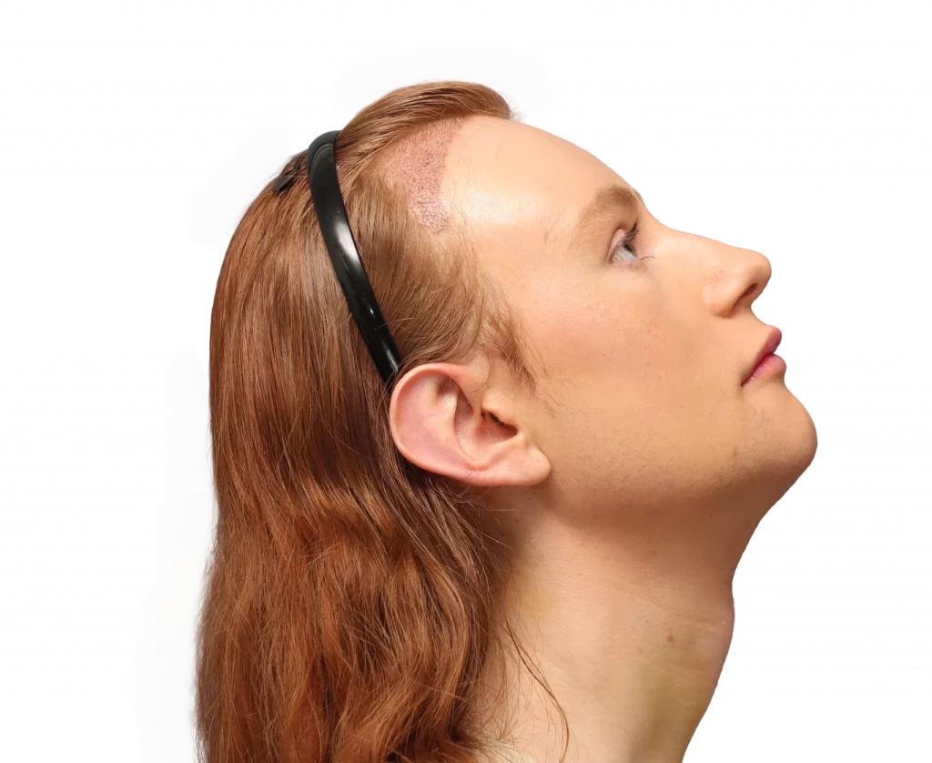 Foto del perfil derecho superior de Annah después de la cirugía.