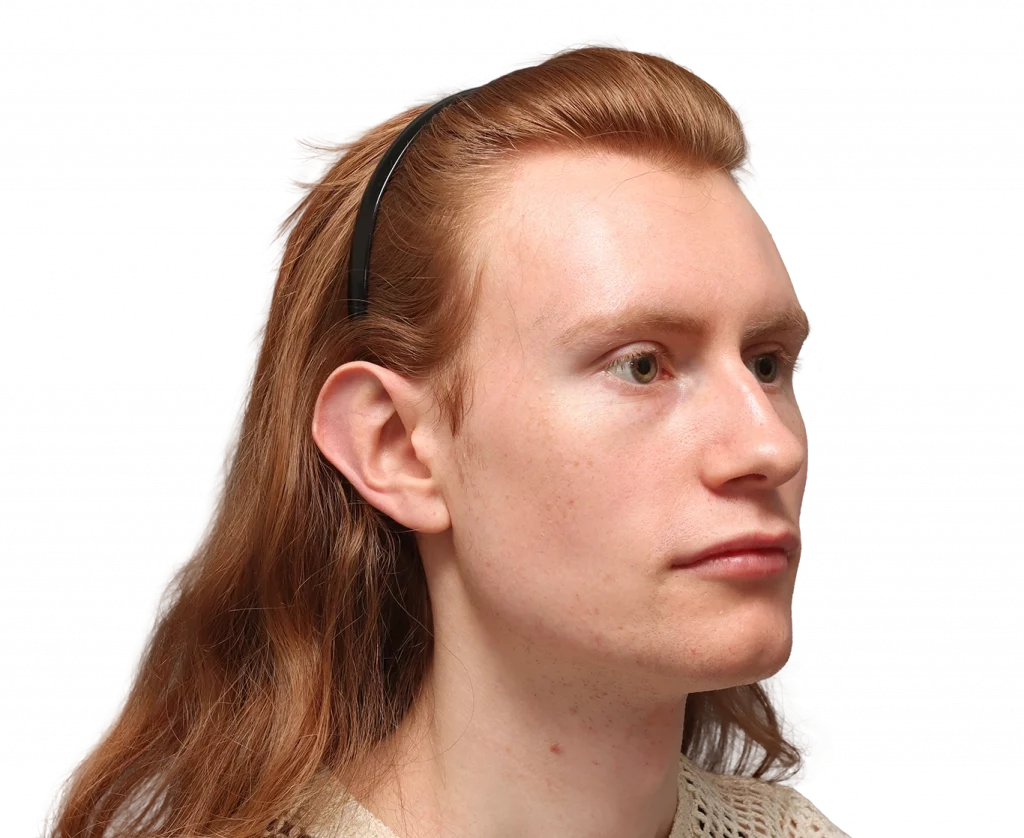 Foto en ángulo del perfil derecho de Annah antes de la cirugía.