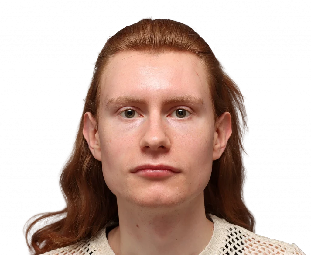 Foto de perfil frontal de Annah antes de la cirugía.