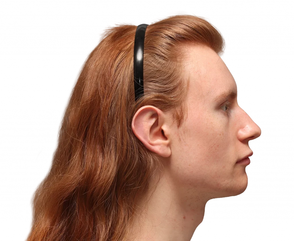 Foto del perfil derecho de Annah antes de la cirugía.