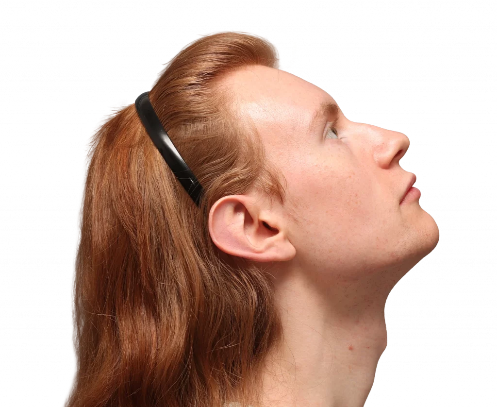 Foto del perfil derecho superior de Annah antes de la cirugía.