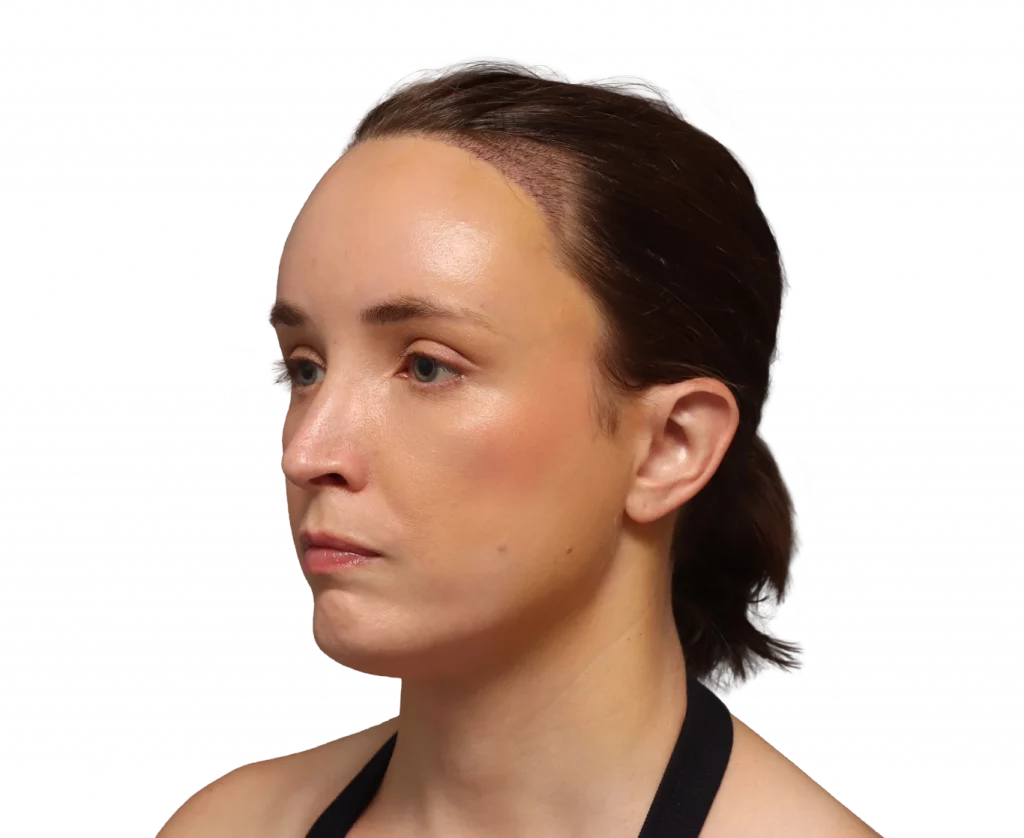 Foto en ángulo del perfil izquierdo de Erin después de la cirugía.