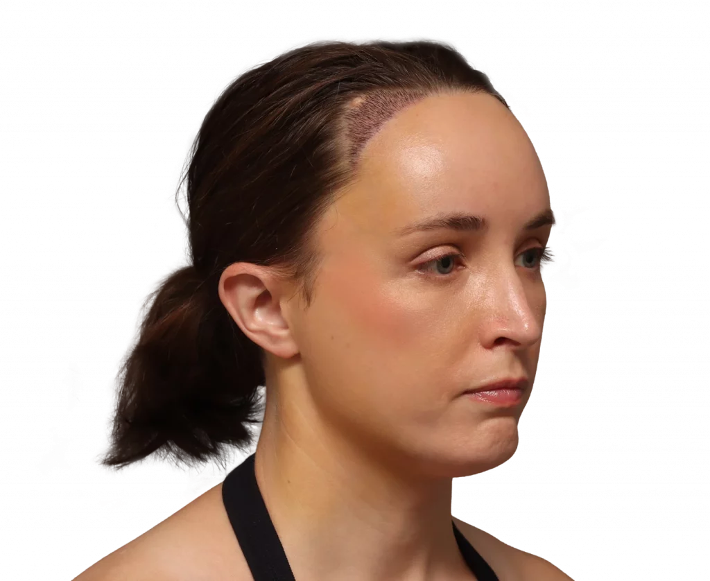 Foto en ángulo del derecho izquierdo de Erin después de la cirugía.