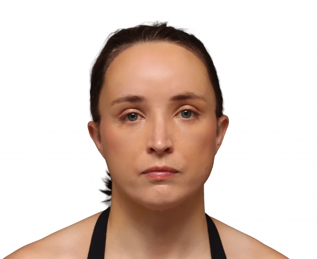 Foto de perfil frontal de Erin después de la cirugía.