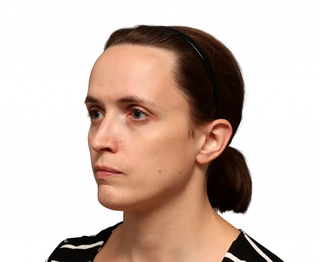 Foto en ángulo del perfil izquierdo de Erin antes de la cirugía.