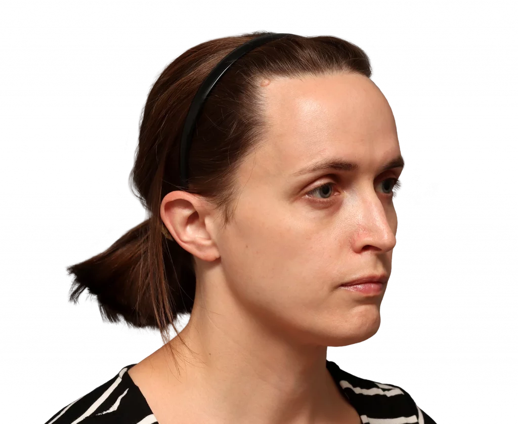 Foto en ángulo del perfil derecho de Erin antes de la cirugía.