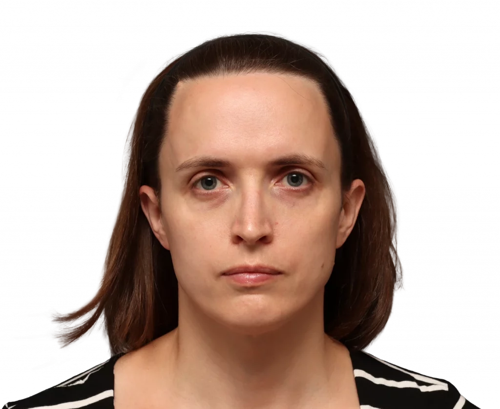 Foto de perfil frontal de Erin antes de la cirugía.