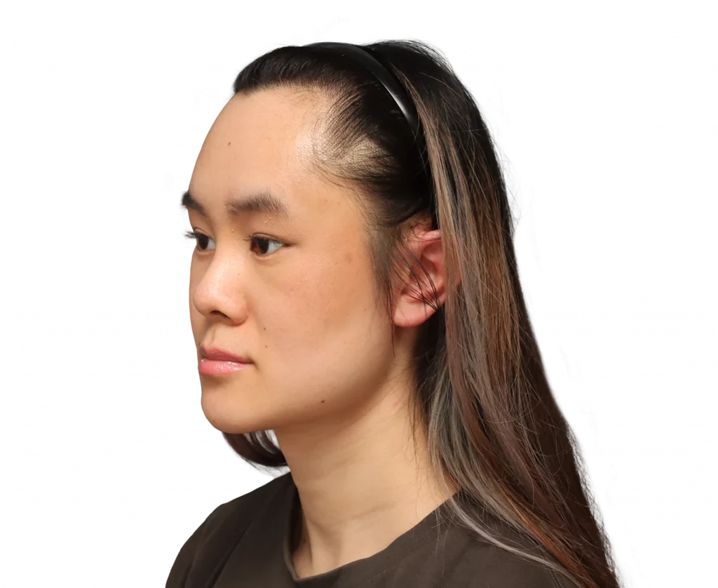 Foto del ángulo del perfil izquierdo de Val después de la cirugía.