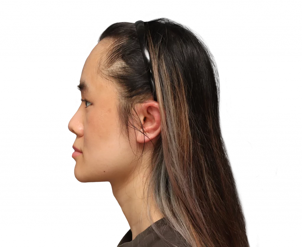 Foto del del perfil izquierdo de Val después de la cirugía.