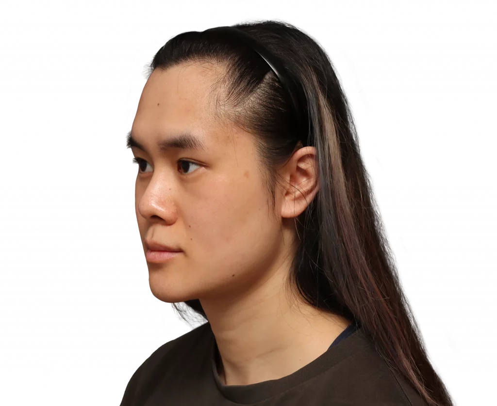 Foto del ángulo del perfil izquierdo de Val antes de la cirugía.