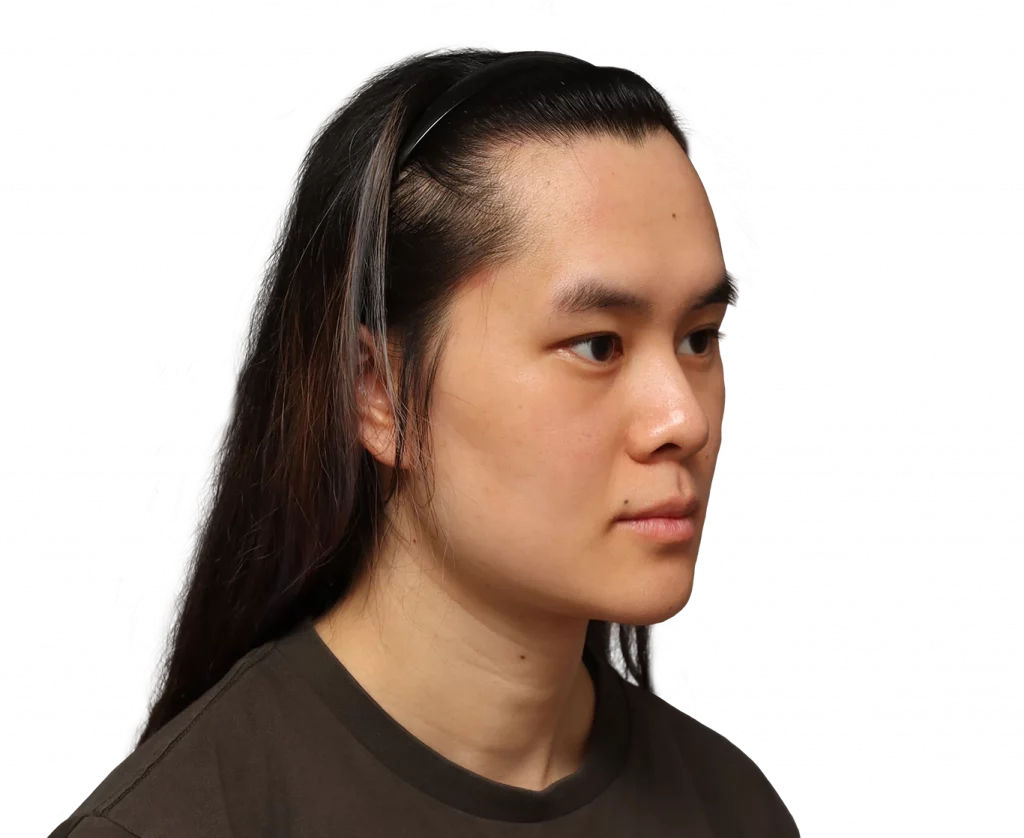 Foto del ángulo del perfil derecho de Val antes de la cirugía.