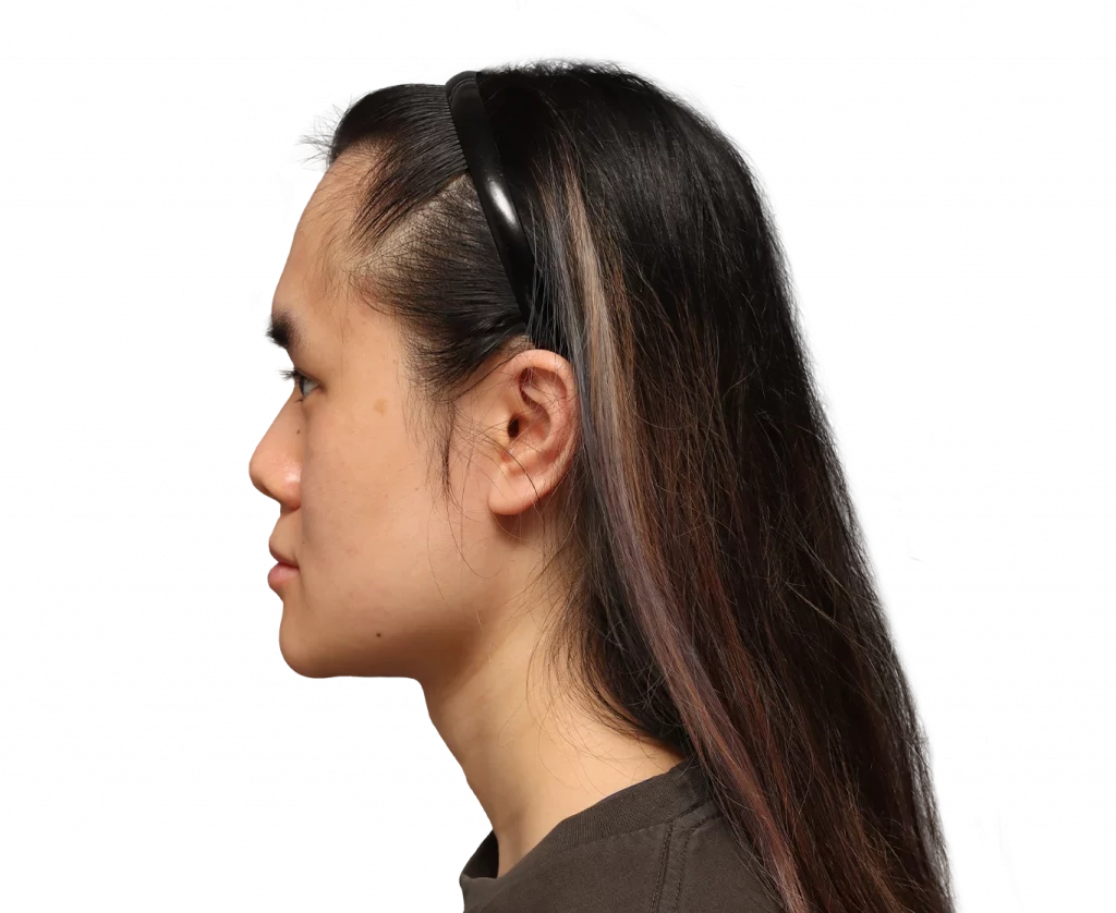 Foto del perfil izquierdo de Val antes de la cirugía.