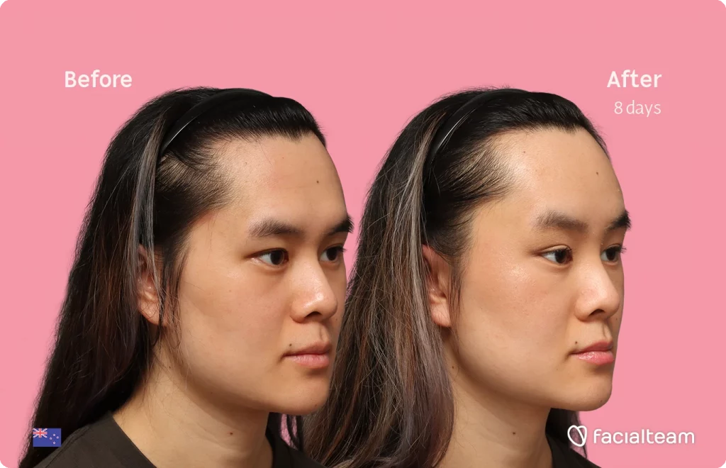 Imagen del del águlo del perfil derecho de la paciente de FFS Val mostrando los resultados del antes y después con Facialteam, consistentes en cirugía de feminización de frente.