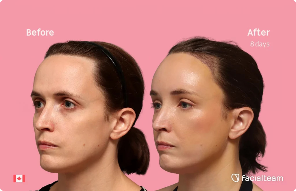 Fotografía en ángulo del perfil izquierdo de Erin, mostrando su transformación antes y después de la FFS con Facialteam: frente con SHT.