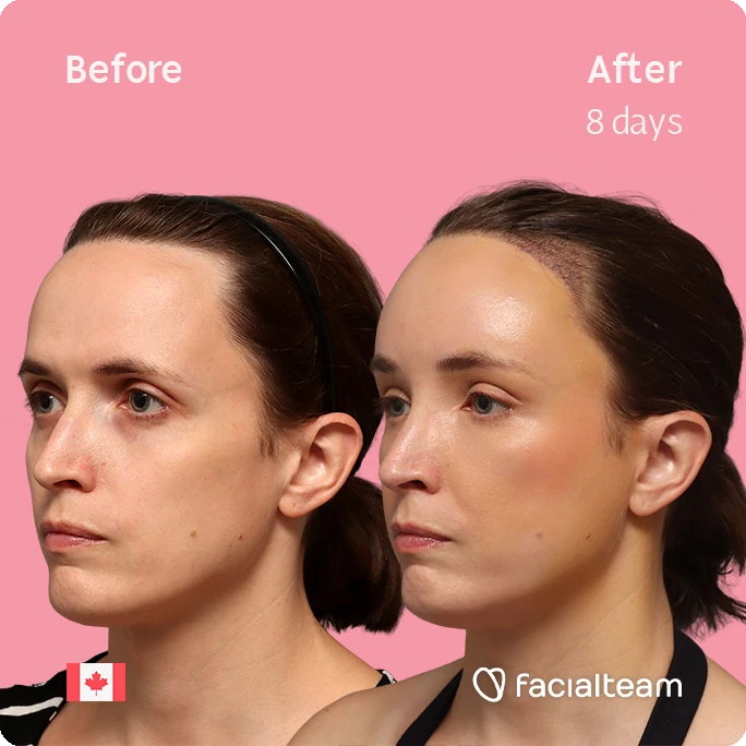 Fotografía cuadrada en ángulo del perfil izquierdo de Erin, mostrando su transformación antes y después de la FFS con Facialteam: frente con SHT.
