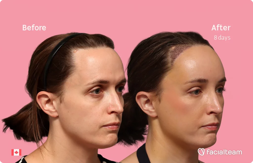 Fotografía en ángulo del perfil derecho de Erin, mostrando su transformación antes y después de la FFS con Facialteam: frente con SHT.