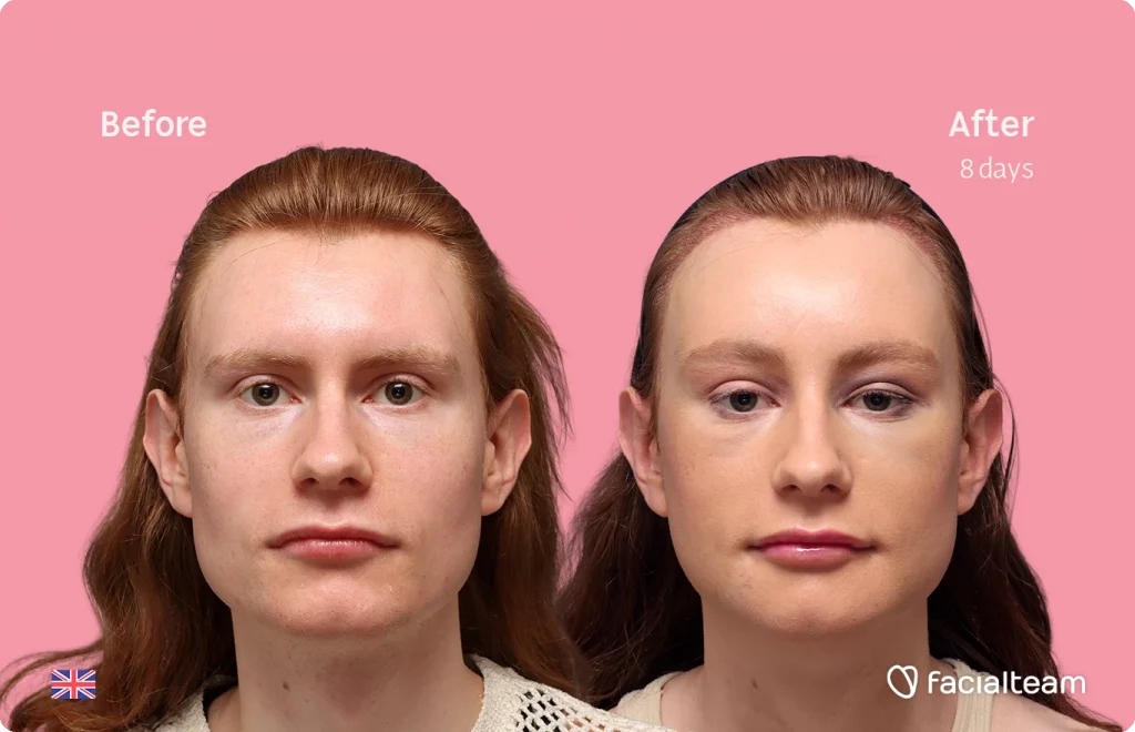Imagen frontal de la paciente de FFS Annah, mostrando los resultados del antes y después con Facialteam, incluyendo feminización de frente, feminización de mentón y reducción de la nuez.