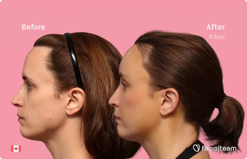 Fotografía del perfil izquierdo de Erin, mostrando su transformación antes y después de la FFS con Facialteam: frente con SHT.