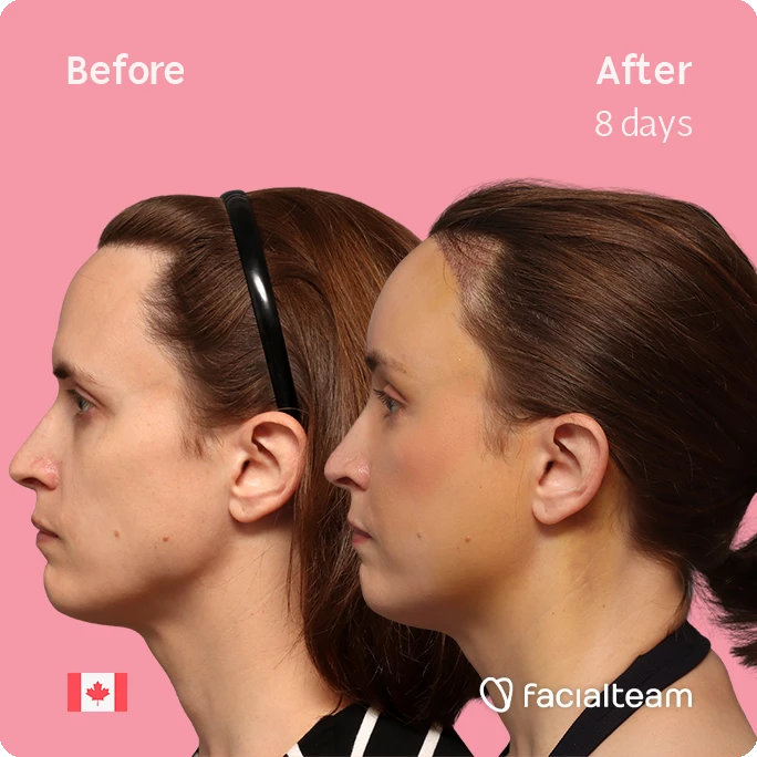 Fotografía cuadrada del perfil izquierdo de Erin, mostrando su transformación antes y después de la FFS con Facialteam: frente con SHT.