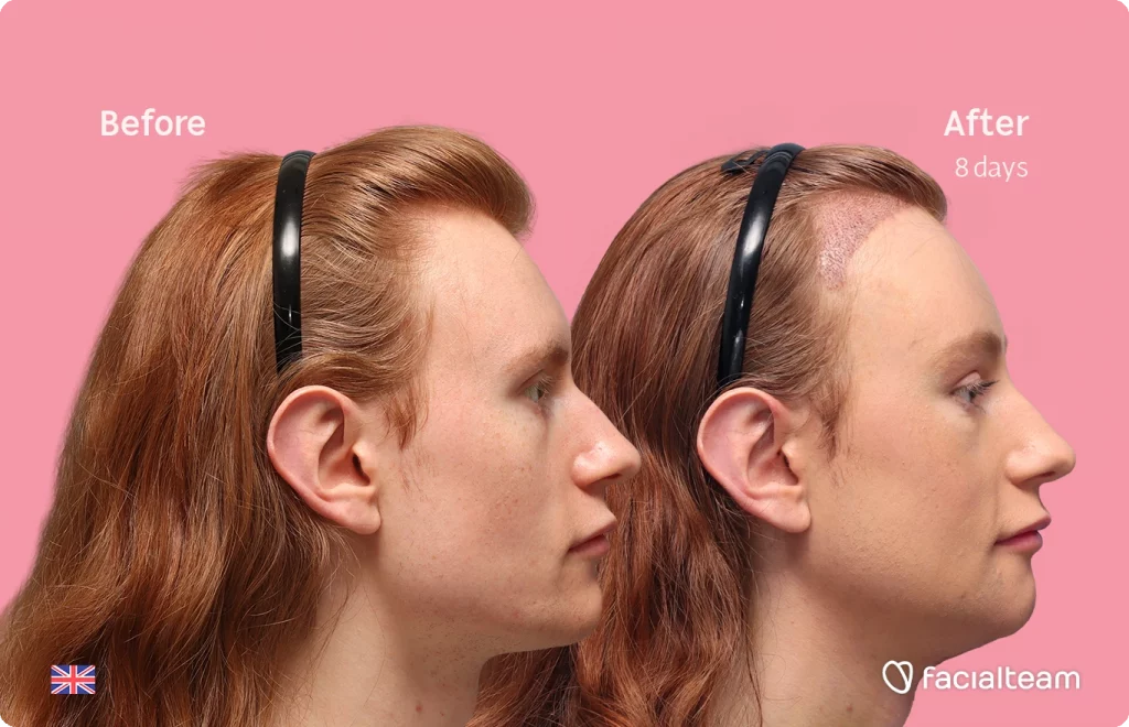 Imagen del perfil derecho de la paciente de FFS Annah, mostrando los resultados del antes y después con Facialteam, incluyendo feminización de frente, feminización de mentón y reducción de la nuez.