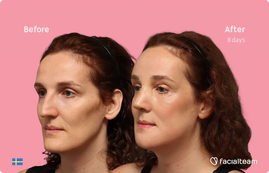 Side-by-side portrait of a woman before and 8 days after treatment on a pink background, showing subtle facial improvement.