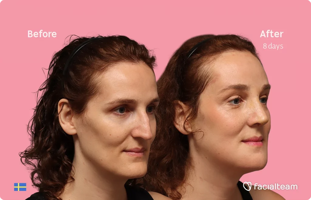 Before and after photos of a woman's face on a pink background; left labeled 'Before', right labeled 'After 8 days' with facialteam logo bottom right and Swedish flag bottom left.