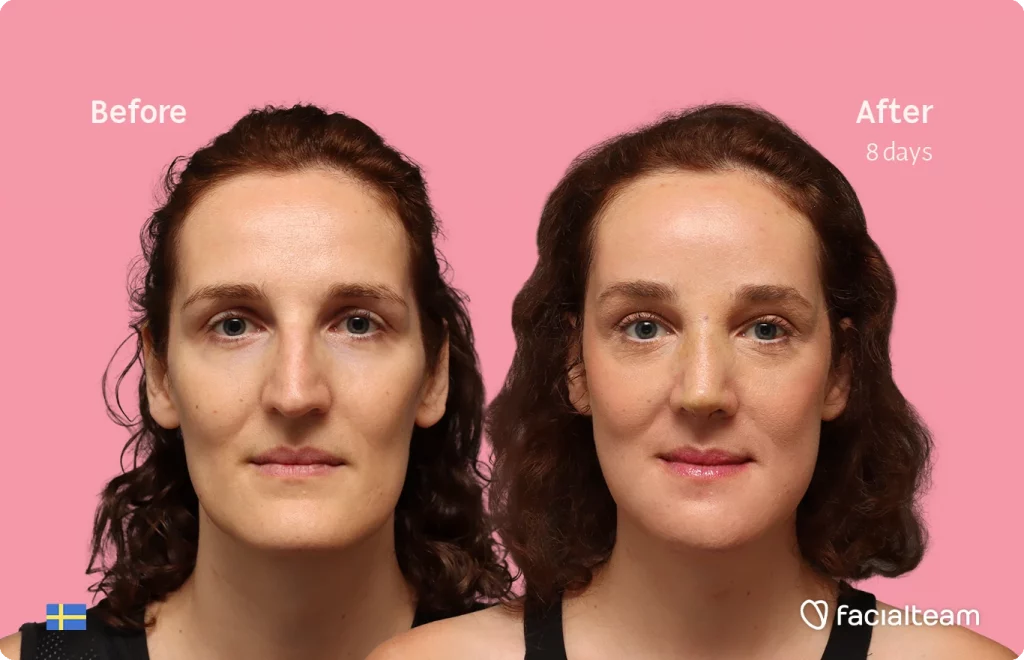 Side-by-side photos of a woman before and after treatment (8 days) on a pink background with the Facialteam logo.