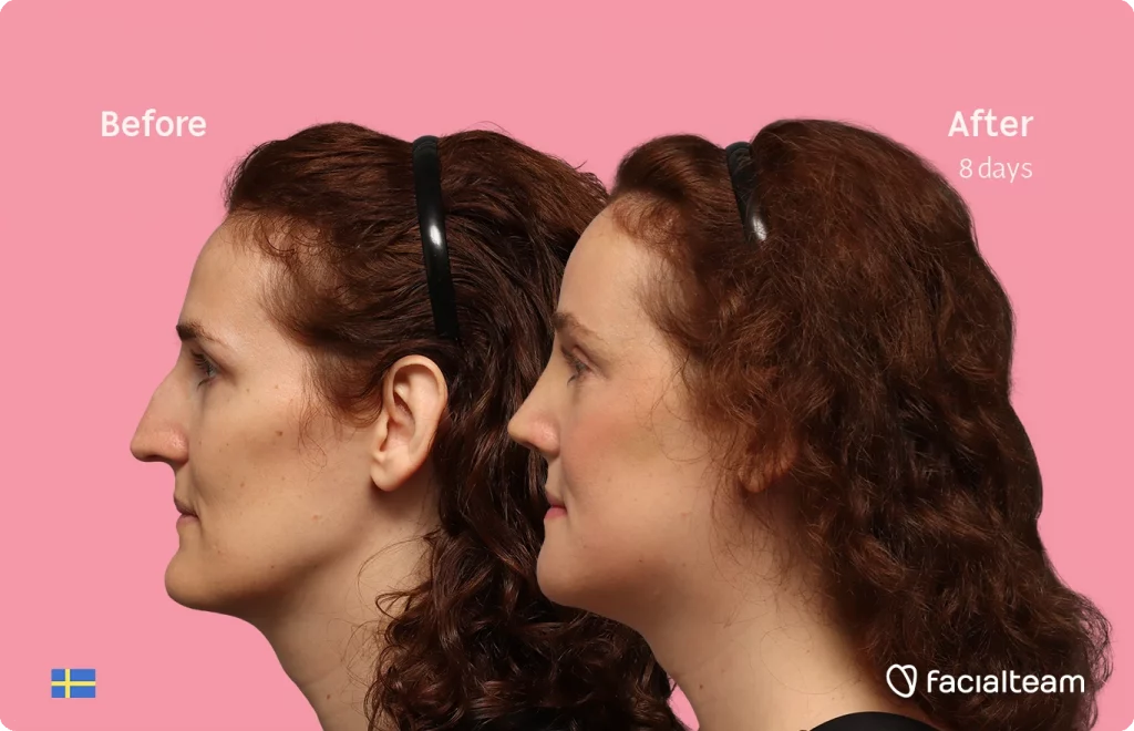 Side-by-side profile photos of a woman labeled 'Before' and 'After 8 days' showing a facial treatment result on a pink background