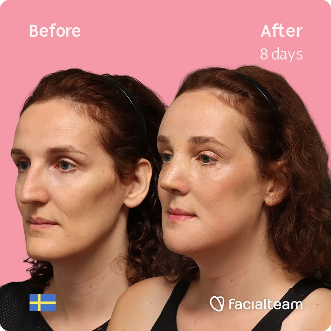 Before and After: side-by-side photos of a woman's face on a pink background, showing the initial appearance on the left and an improved complexion after 8 days on the right; includes FacialTeam logo.
