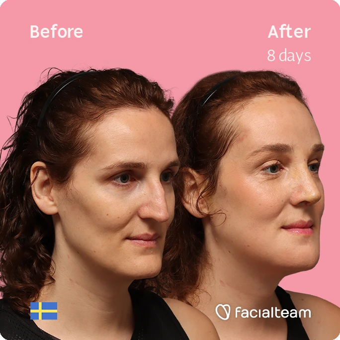 Before and After comparison of a woman's face after 8 days of treatment, showing clearer skin and improved contour; pink background, Facialteam logo bottom right, Swedish flag bottom left