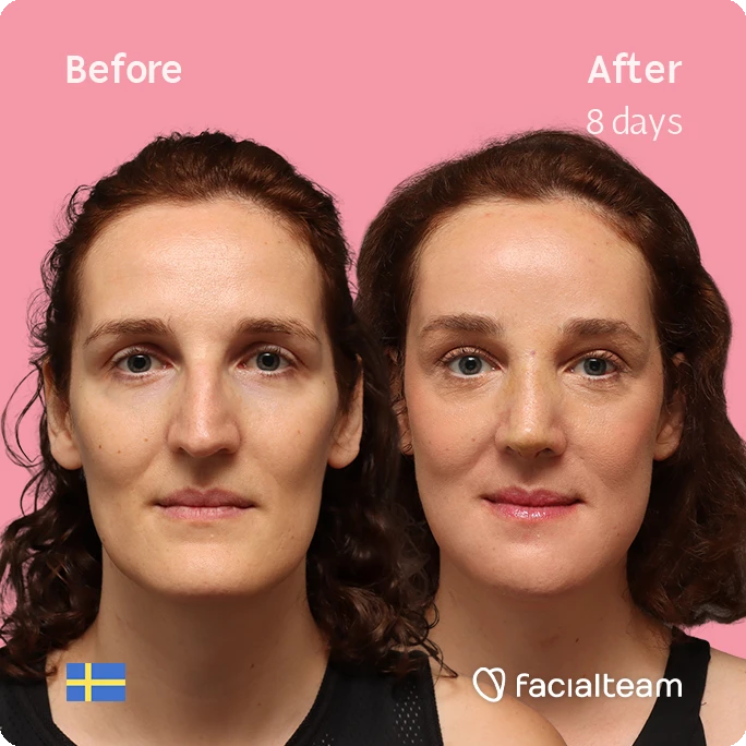 Side-by-side portrait of a woman: left shows before treatment, right shows after 8 days with smoother skin on a pink background. Brand watermark and small Swedish flag visible.