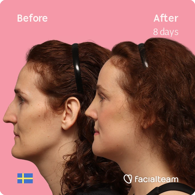 Side-by-side profile of a woman's face labeled Before and After 8 days, pink background, facial treatment comparison.
