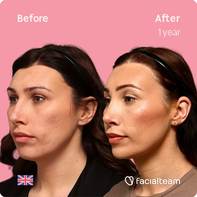 Side-by-side portraits: left shows 'Before', right shows 'After 1 year'—woman’s facial transformation on pink background with FacialTeam branding