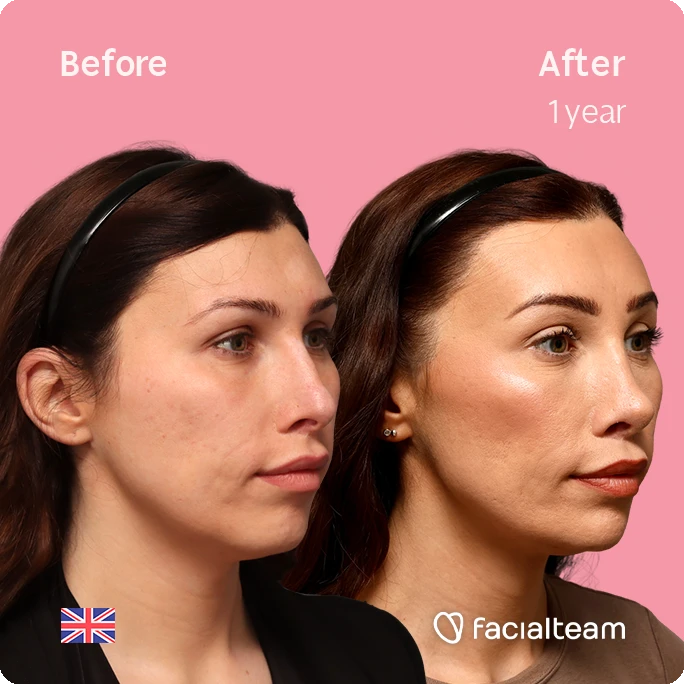 Side-by-side before and after portrait of a woman after one year of treatment; pink background, Facialteam branding.