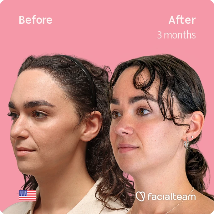 Side-by-side profile of a woman before and after 3 months of facial treatment on a pink background with Faciaalteam logo.