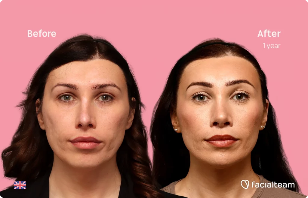 Before and after portrait of a woman (1 year later): smoother skin, fuller eyebrows, and defined lips against a pink background; facialteam logo and UK flag visible.