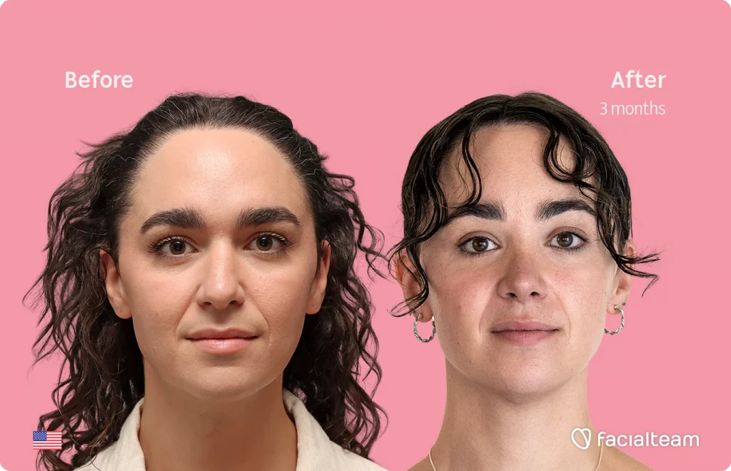 Before and after portrait of a woman facing the camera; left shows the “before” look, right shows the “after” look after 3 months against a pink background with Facial Team branding.